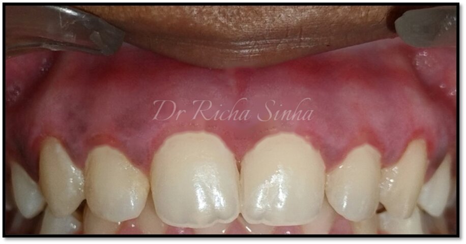 After gingival depigmentation — even natural pink gum tone