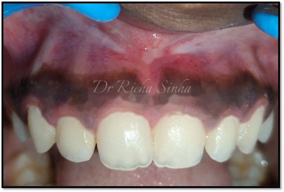 Before gingival depigmentation — pigmented gum tissue