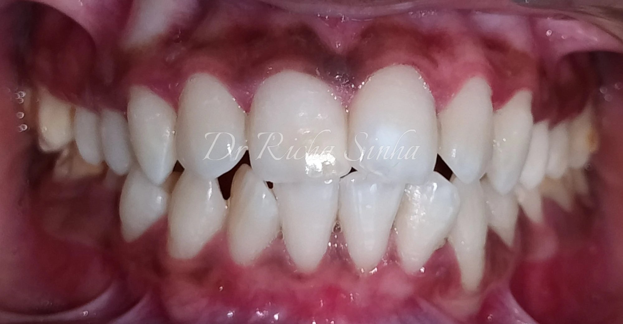 After scaling and root planing — healthy gum contour