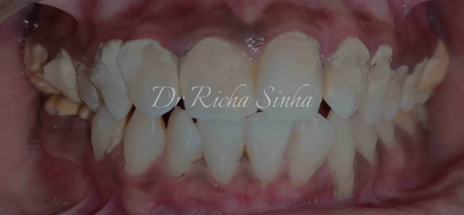 Before scaling and root planing — inflamed gum tissue